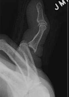 Dorsal Dislocation Simple